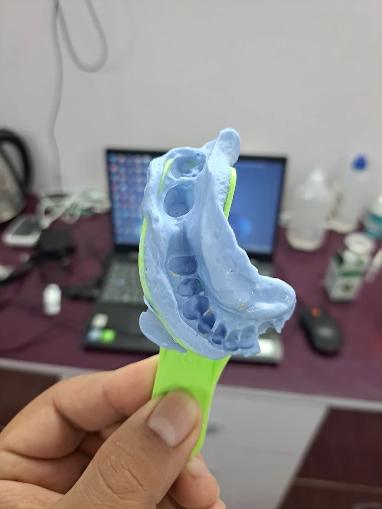 Dental Impression